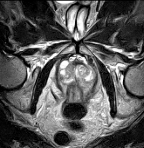 Prostate Axial MRI scan